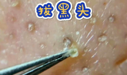 挤粉刺视频,告别痘痘困扰！